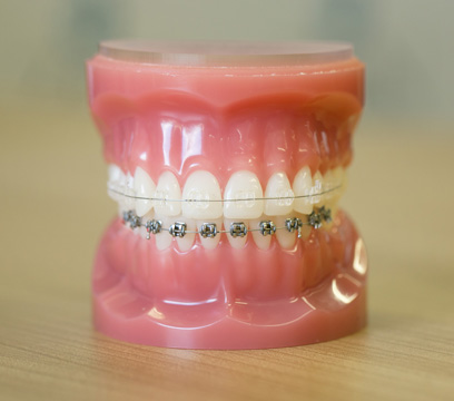 Cosmetic clear braces